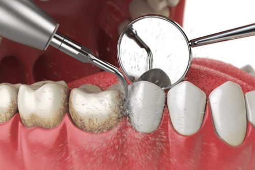 Diş taşı temizliği (detertraj) uygulaması