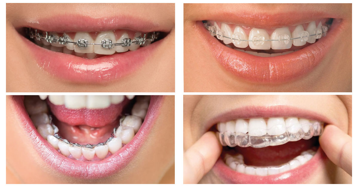 Ortodontik tedavi uygulaması